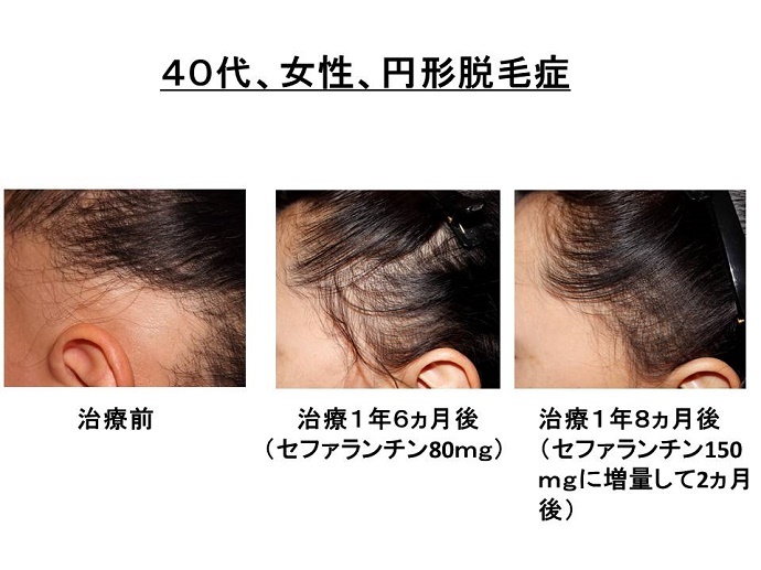 円形脱毛症　病院